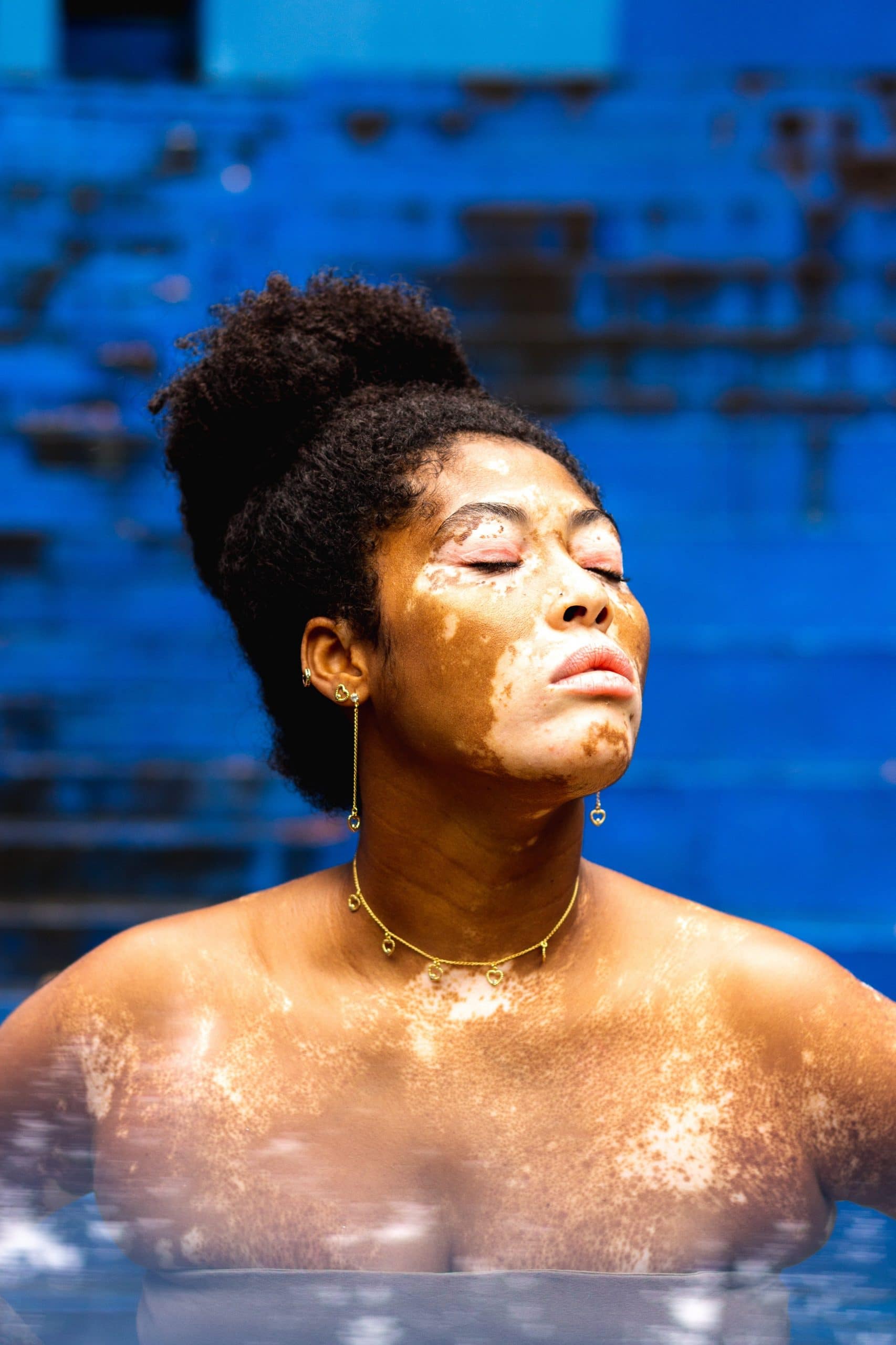 Piperina e vitiligine: possibile soluzione?