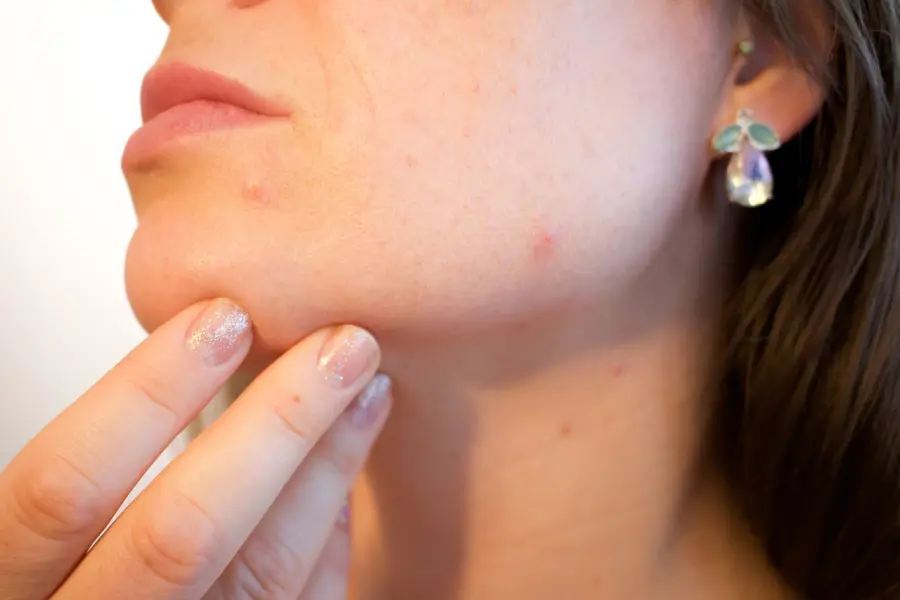 Acne e brufoli: cause e rimedi