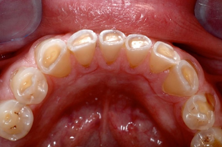 denti limati da eccessivo sfregamento